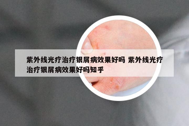 紫外线光疗治疗银屑病效果好吗 紫外线光疗治疗银屑病效果好吗知乎
