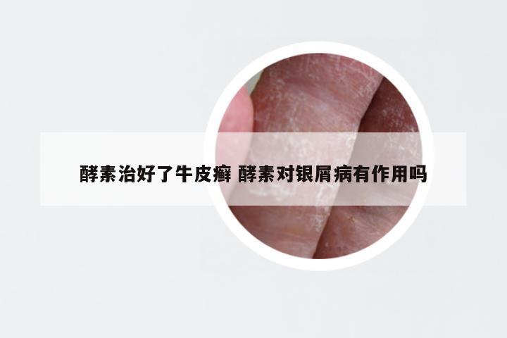 酵素治好了牛皮癣 酵素对银屑病有作用吗