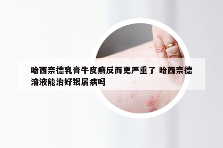 哈西奈德乳膏牛皮癣反而更严重了 哈西奈德溶液能治好银屑病吗