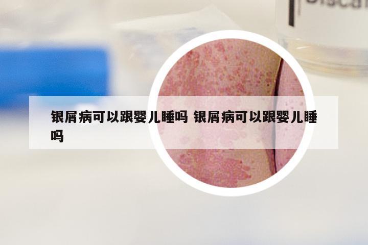 银屑病可以跟婴儿睡吗 银屑病可以跟婴儿睡吗
