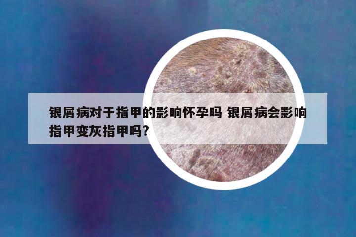 银屑病对于指甲的影响怀孕吗 银屑病会影响指甲变灰指甲吗?