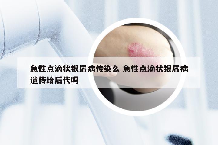 急性点滴状银屑病传染么 急性点滴状银屑病遗传给后代吗