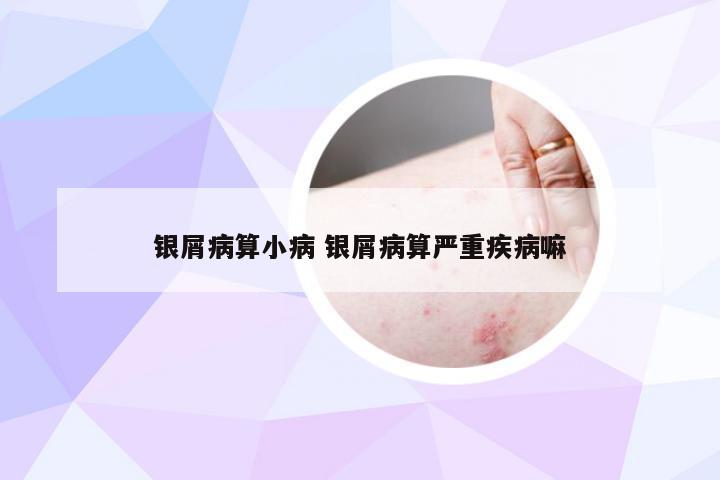 银屑病算小病 银屑病算严重疾病嘛