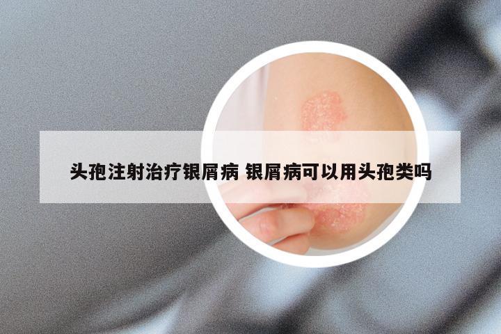 头孢注射治疗银屑病 银屑病可以用头孢类吗