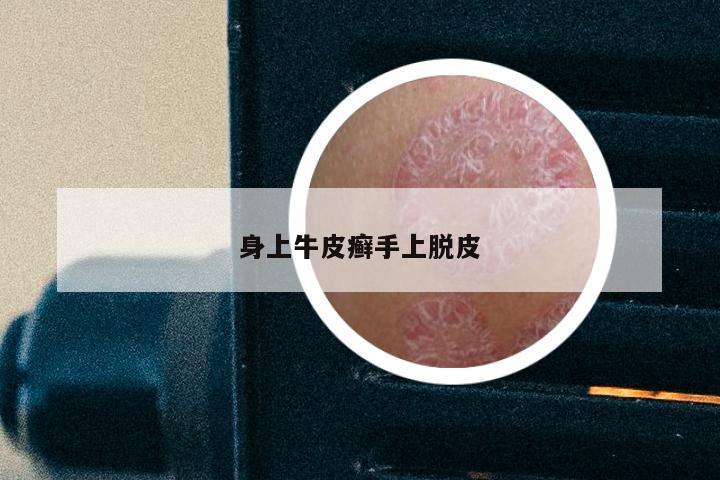 身上牛皮癣手上脱皮
