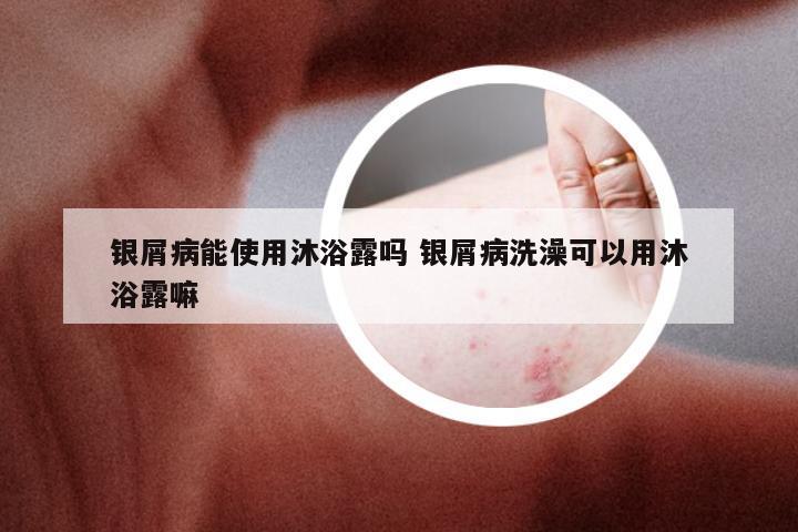 银屑病能使用沐浴露吗 银屑病洗澡可以用沐浴露嘛