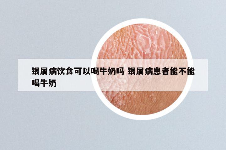 银屑病饮食可以喝牛奶吗 银屑病患者能不能喝牛奶