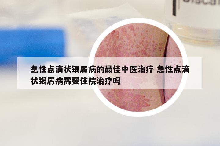 急性点滴状银屑病的最佳中医治疗 急性点滴状银屑病需要住院治疗吗