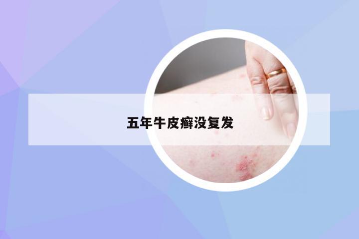 五年牛皮癣没复发