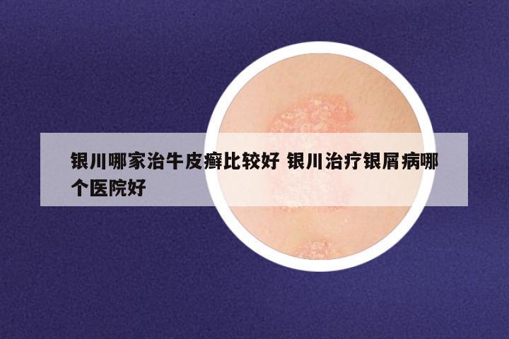 银川哪家治牛皮癣比较好 银川治疗银屑病哪个医院好