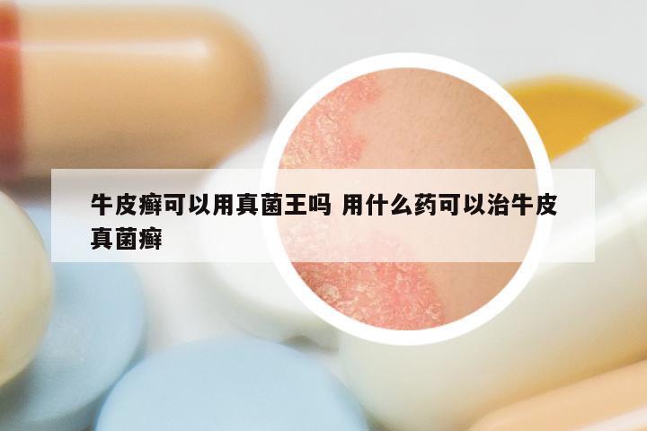 牛皮癣可以用真菌王吗 用什么药可以治牛皮真菌癣