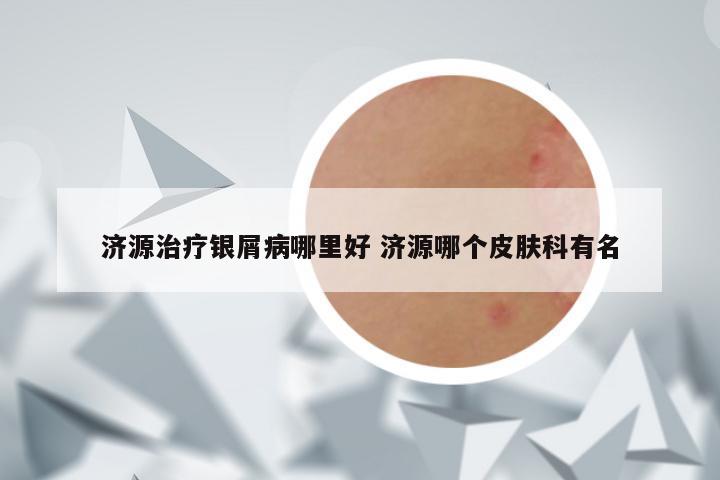 济源治疗银屑病哪里好 济源哪个皮肤科有名