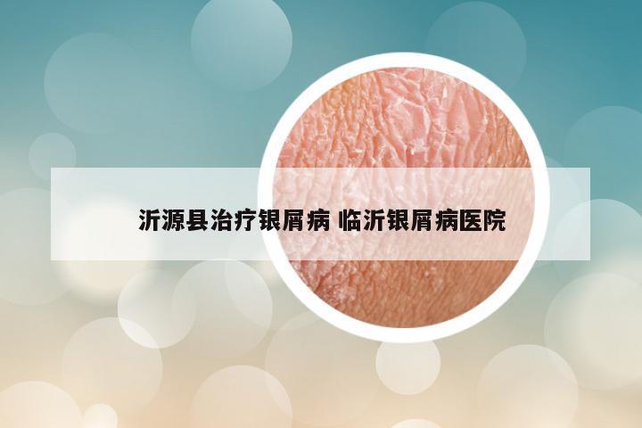 沂源县治疗银屑病 临沂银屑病医院