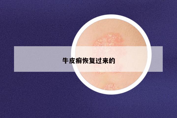 牛皮癣恢复过来的