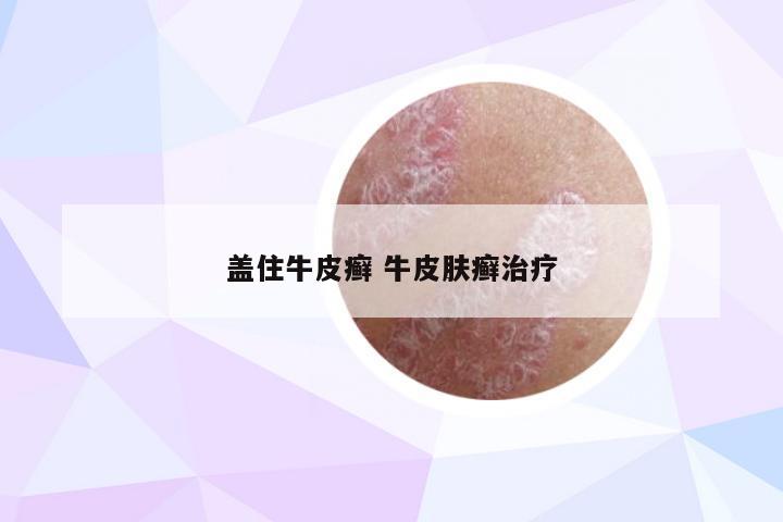 盖住牛皮癣 牛皮肤癣治疗