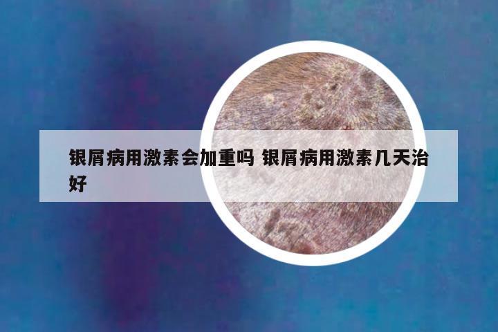 银屑病用激素会加重吗 银屑病用激素几天治好