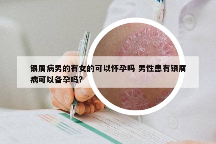 银屑病男的有女的可以怀孕吗 男性患有银屑病可以备孕吗?