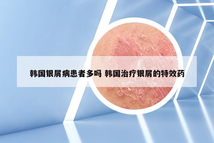 韩国银屑病患者多吗 韩国治疗银屑的特效药