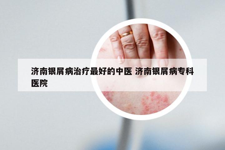 济南银屑病治疗最好的中医 济南银屑病专科医院