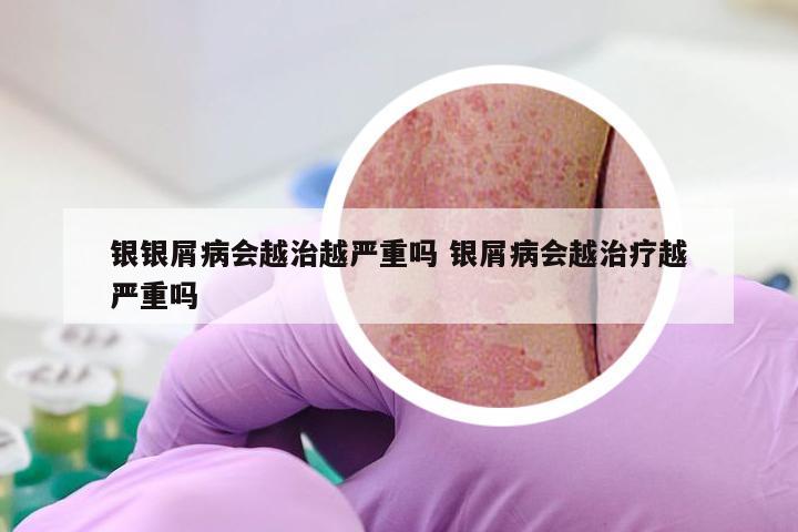银银屑病会越治越严重吗 银屑病会越治疗越严重吗