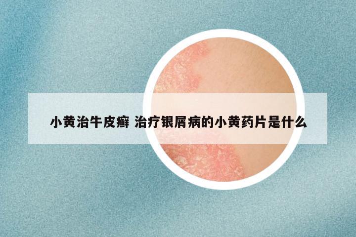 小黄治牛皮癣 治疗银屑病的小黄药片是什么