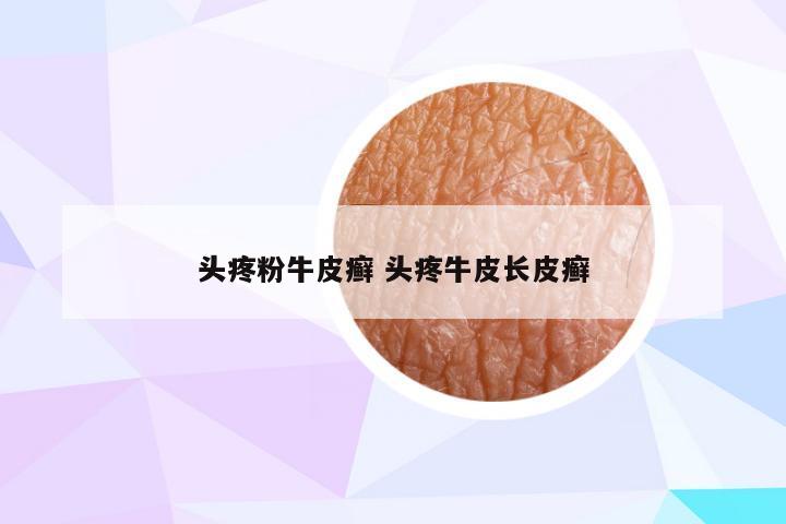 头疼粉牛皮癣 头疼牛皮长皮癣