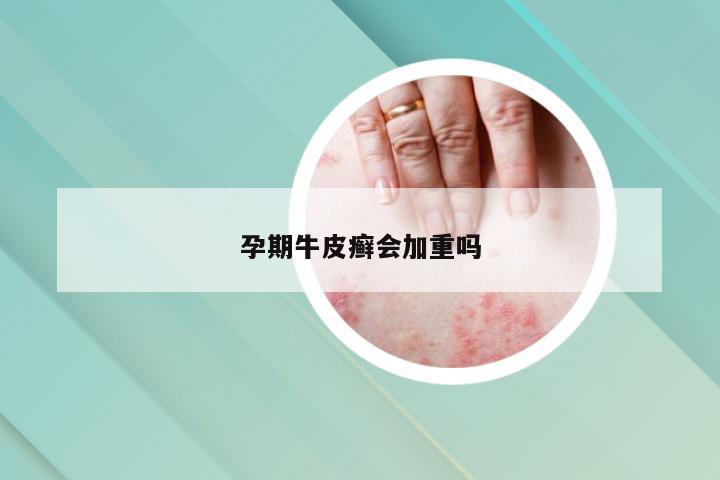 孕期牛皮癣会加重吗