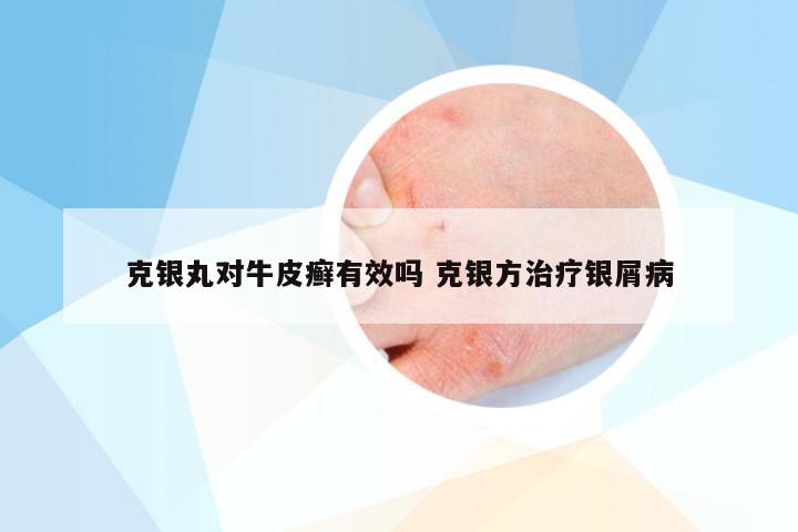 克银丸对牛皮癣有效吗 克银方治疗银屑病