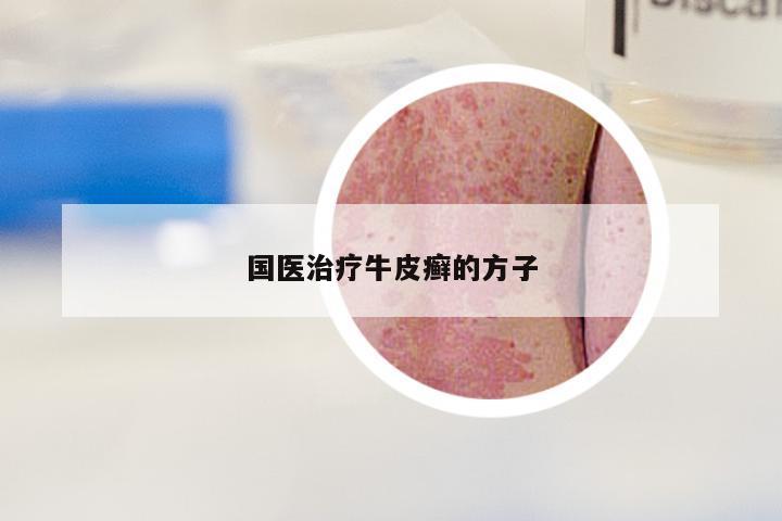国医治疗牛皮癣的方子