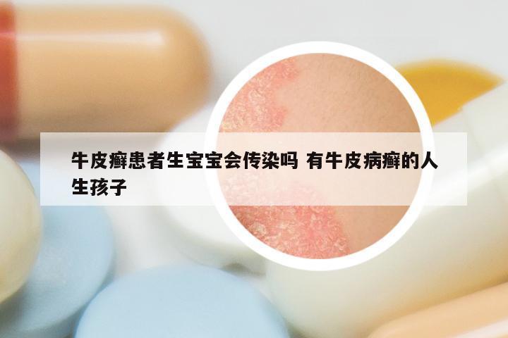 牛皮癣患者生宝宝会传染吗 有牛皮病癣的人生孩子