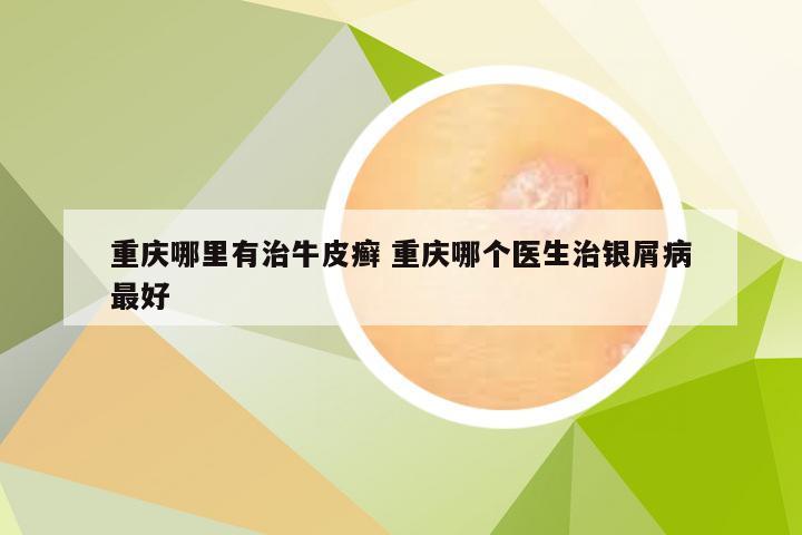 重庆哪里有治牛皮癣 重庆哪个医生治银屑病最好