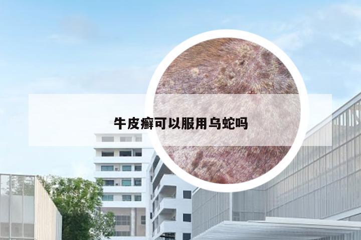 牛皮癣可以服用乌蛇吗