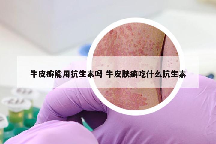 牛皮癣能用抗生素吗 牛皮肤癣吃什么抗生素