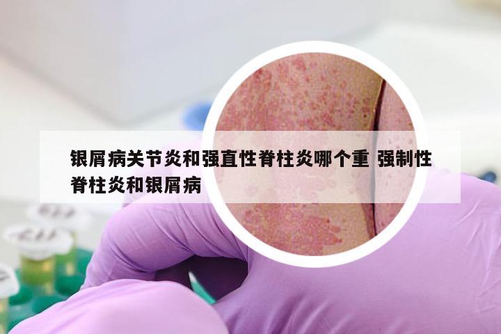 银屑病关节炎和强直性脊柱炎哪个重 强制性脊柱炎和银屑病