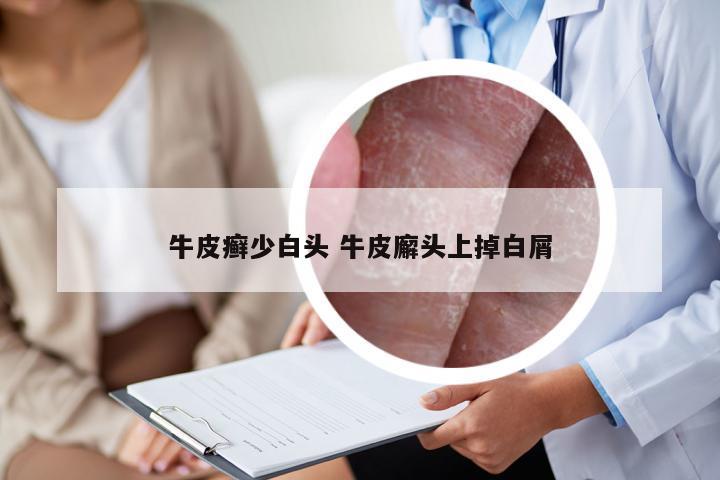 牛皮癣少白头 牛皮廨头上掉白屑