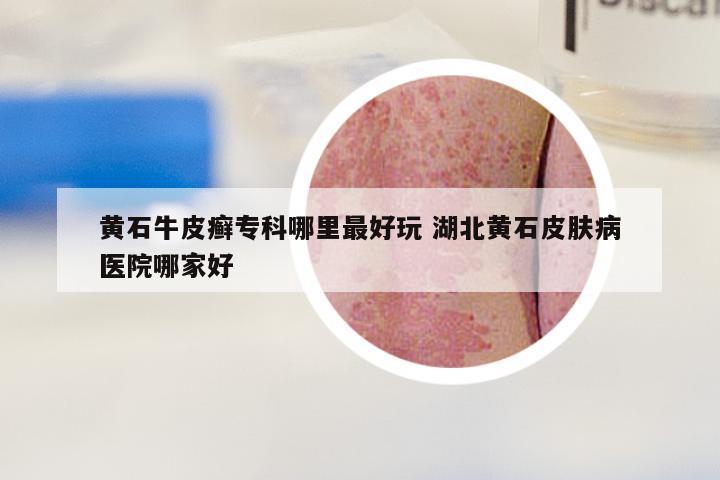 黄石牛皮癣专科哪里最好玩 湖北黄石皮肤病医院哪家好