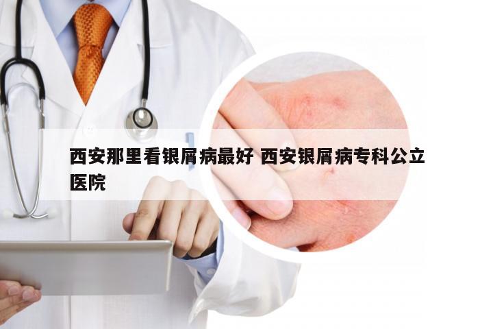 西安那里看银屑病最好 西安银屑病专科公立医院