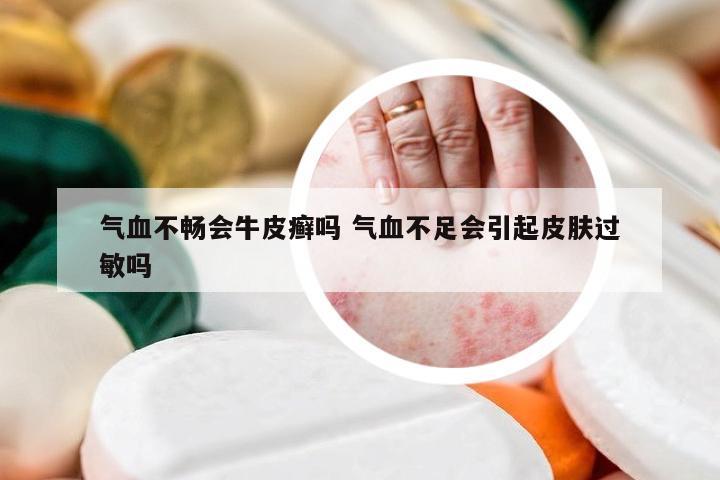 气血不畅会牛皮癣吗 气血不足会引起皮肤过敏吗