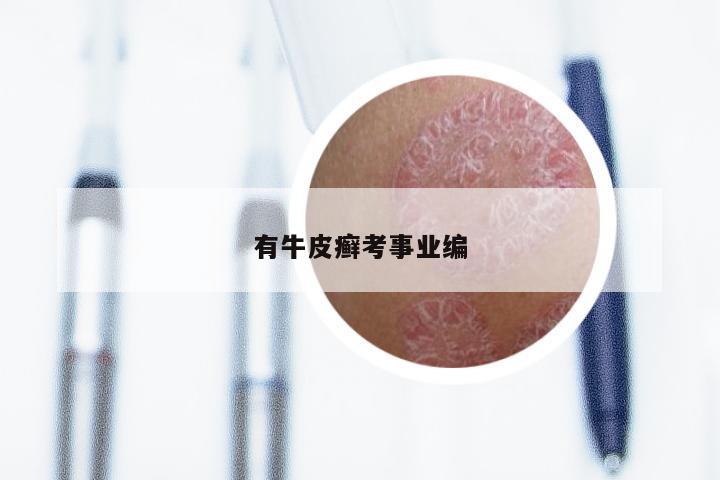 有牛皮癣考事业编
