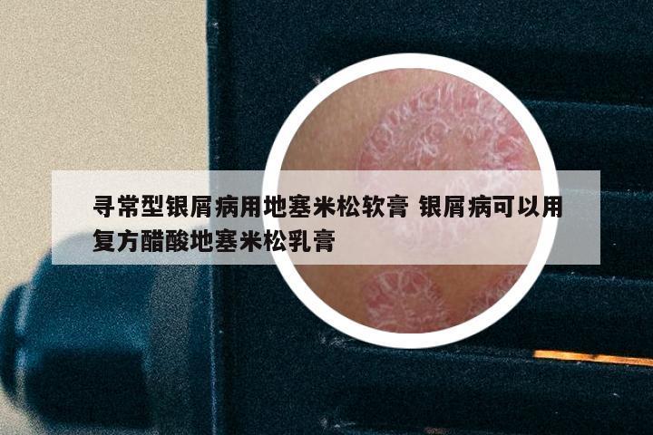 寻常型银屑病用地塞米松软膏 银屑病可以用复方醋酸地塞米松乳膏