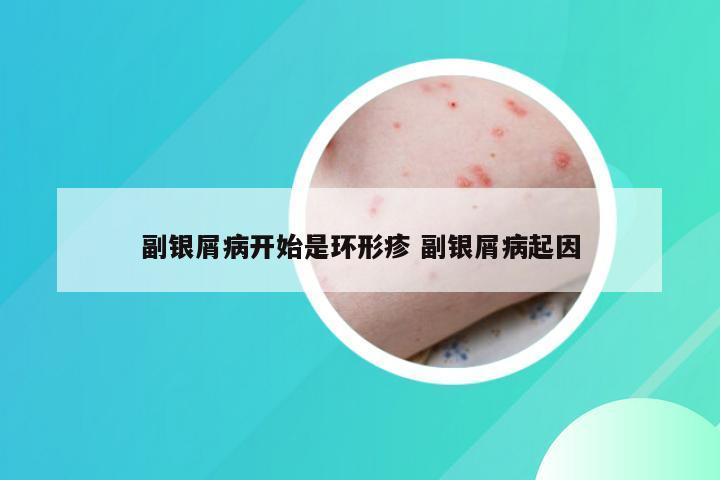 副银屑病开始是环形疹 副银屑病起因