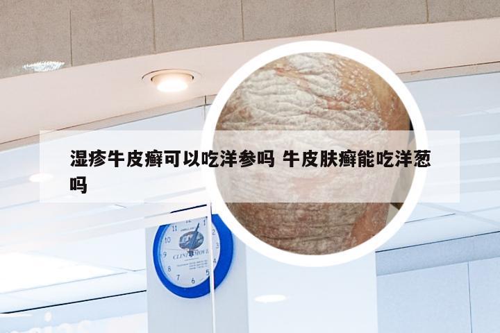 湿疹牛皮癣可以吃洋参吗 牛皮肤癣能吃洋葱吗
