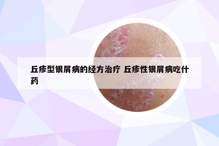 丘疹型银屑病的经方治疗 丘疹性银屑病吃什药