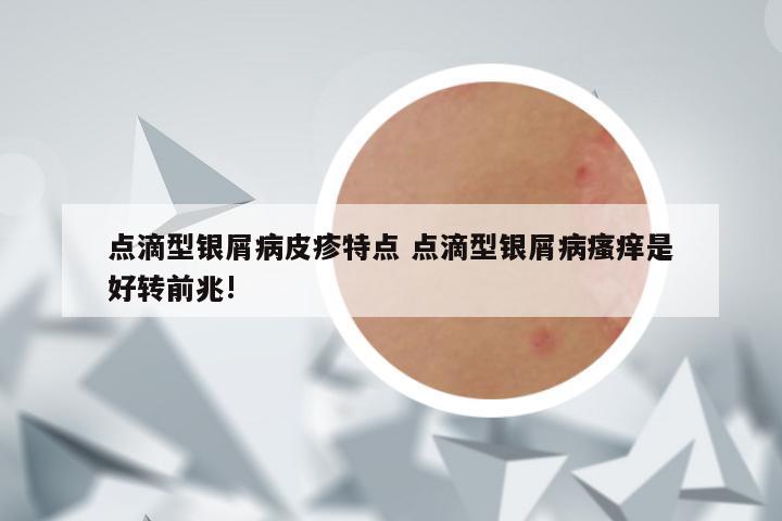 点滴型银屑病皮疹特点 点滴型银屑病瘙痒是好转前兆!