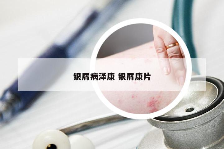 银屑病泽康 银屑康片
