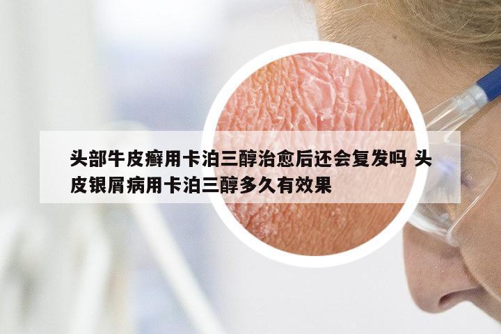 头部牛皮癣用卡泊三醇治愈后还会复发吗 头皮银屑病用卡泊三醇多久有效果