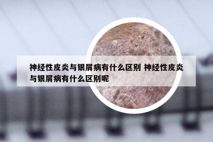 神经性皮炎与银屑病有什么区别 神经性皮炎与银屑病有什么区别呢