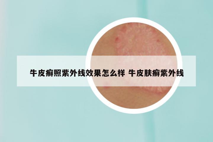 牛皮癣照紫外线效果怎么样 牛皮肤癣紫外线