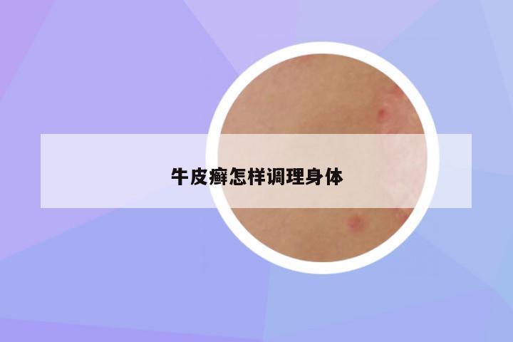 牛皮癣怎样调理身体