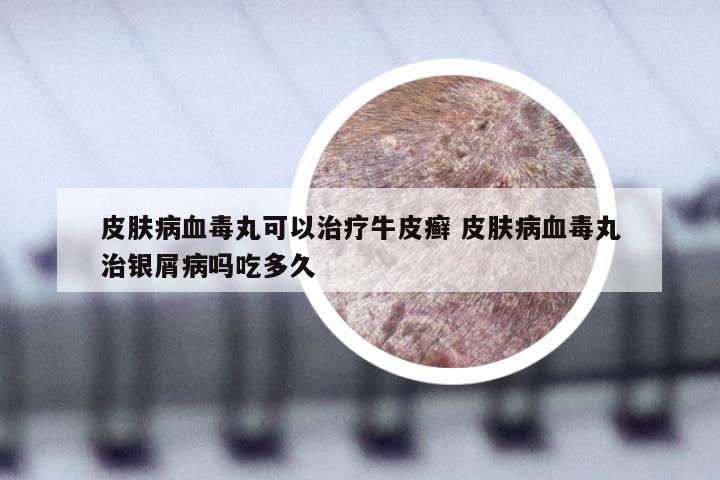 皮肤病血毒丸可以治疗牛皮癣 皮肤病血毒丸治银屑病吗吃多久